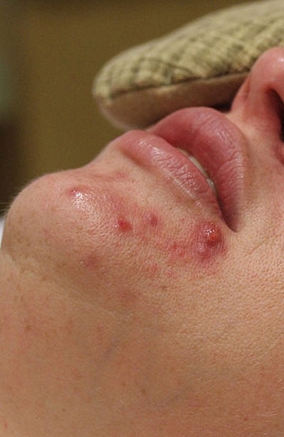 Custom Acne Regimen Before & After