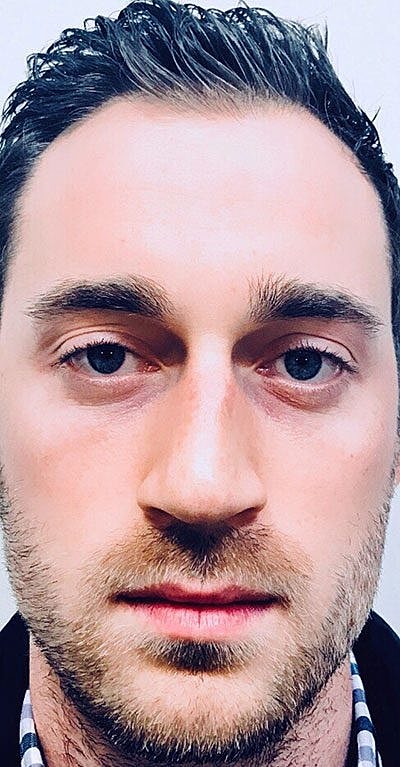 Tear Trough Filler Before & After