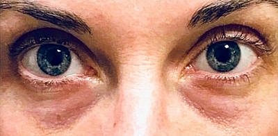 Tear Trough Filler Before & After