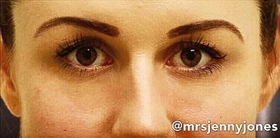 Tear Trough Filler Before & After