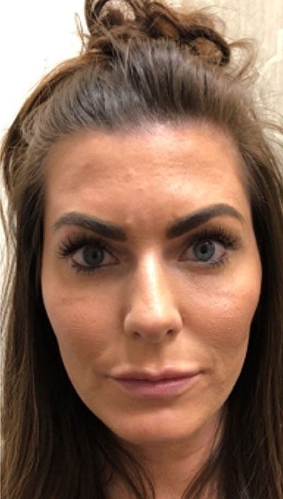 Cheek Filler Before & After