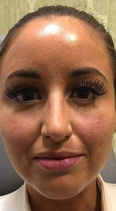 Fillers Before & After