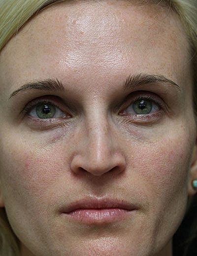 Fillers Before & After