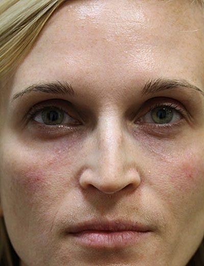 Fillers Before & After