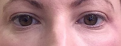 Fillers Before & After