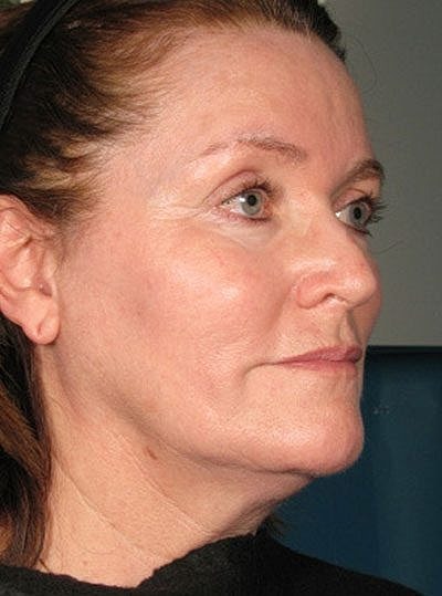 Ultherapy Before & After