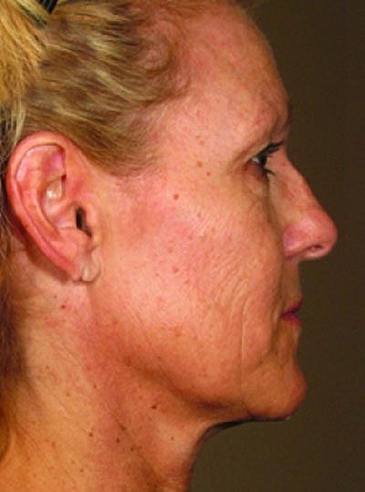 Ultherapy Before & After