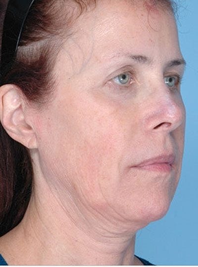 Ultherapy Before & After