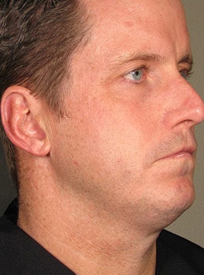 Ultherapy Before & After