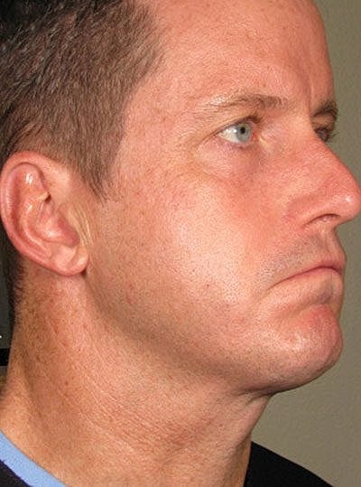 Ultherapy Before & After