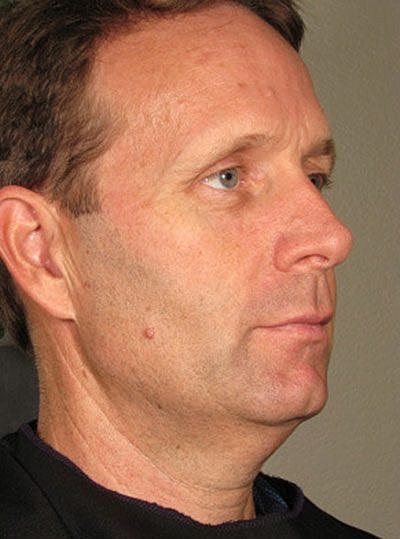 Ultherapy Before & After