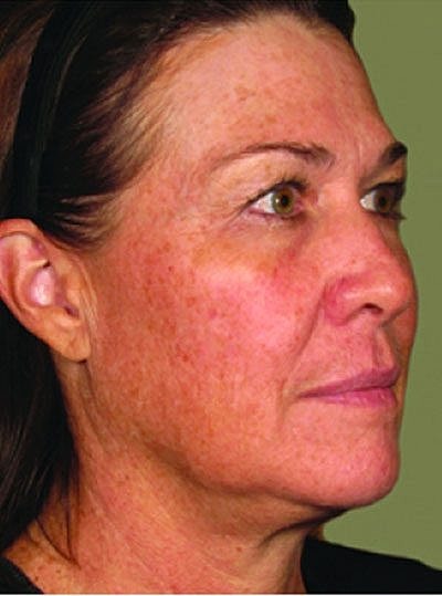 Ultherapy Before & After