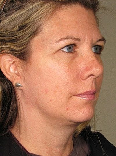 Ultherapy Before & After