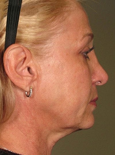 Ultherapy Before & After