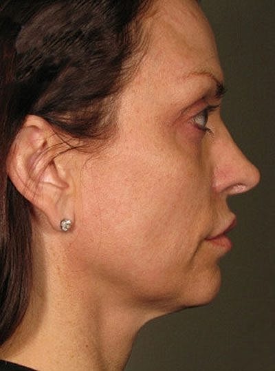 Ultherapy Before & After