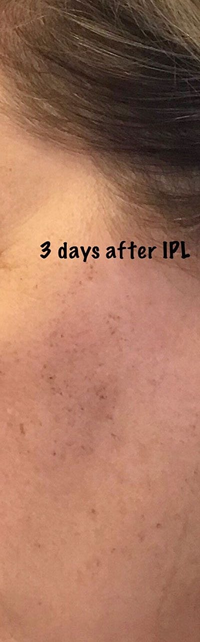 Ipl Laser Before & After