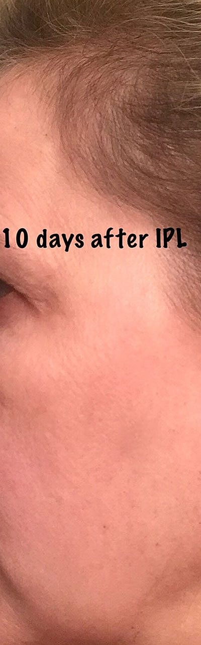 Ipl Laser Before & After