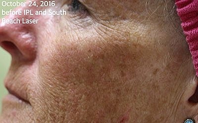 Ipl Laser Before & After