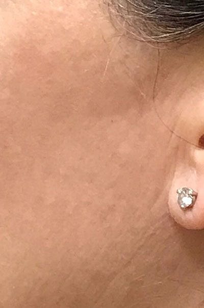 Ipl Laser Before & After