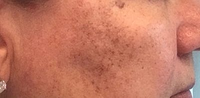 Ipl Laser Before & After