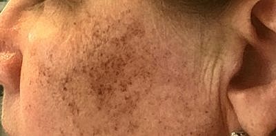 Ipl Laser Before & After