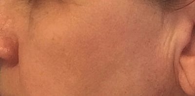 Ipl Laser Before & After