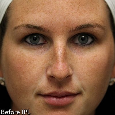 Ipl Laser Before & After