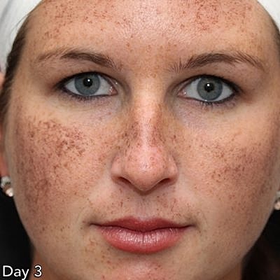 Ipl Laser Before & After