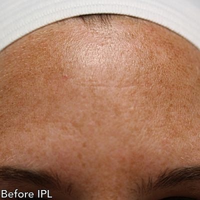 Ipl Laser Before & After