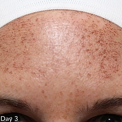 Ipl Laser Before & After