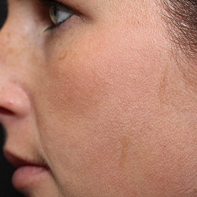 IPL Laser Before & After