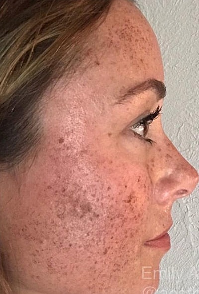 Ipl Laser Before & After