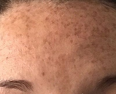 Ipl Laser Before & After