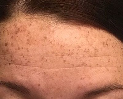 Ipl Laser Before & After