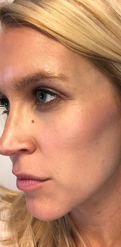 Ipl Laser Before & After