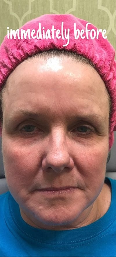 IPL Laser Before & After