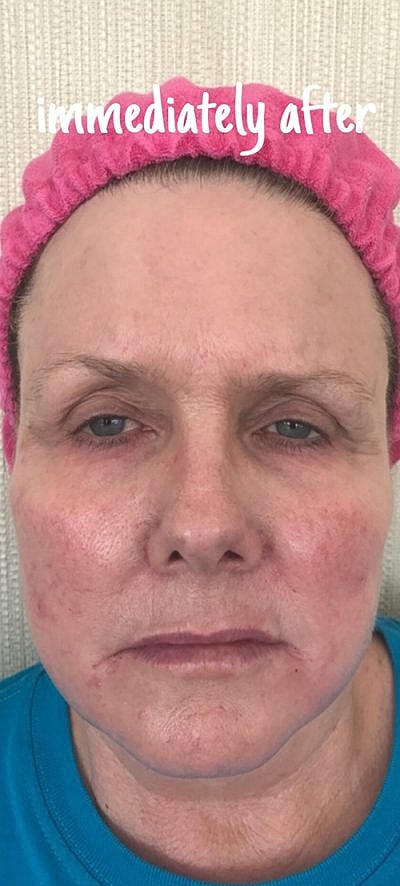 IPL Laser Before & After