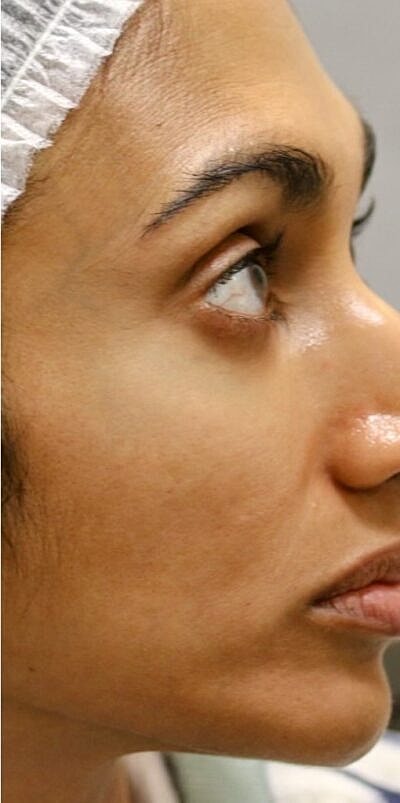 Microneedling Before & After