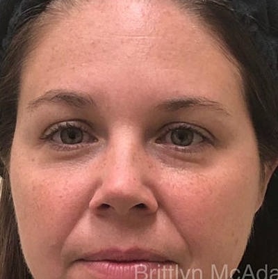 Laser Before & After