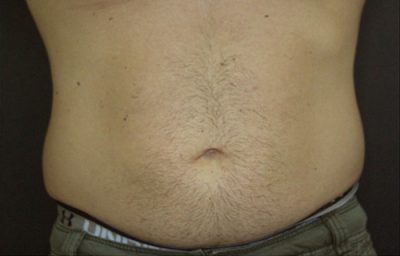 CoolSculpting Before Photo