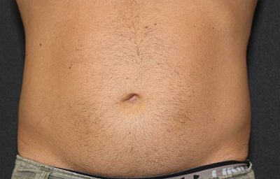 CoolSculpting After Photo