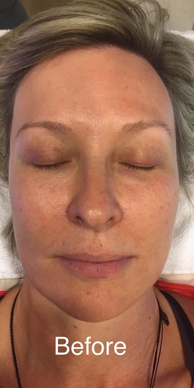 HydraFacial Before Photo St. Louis