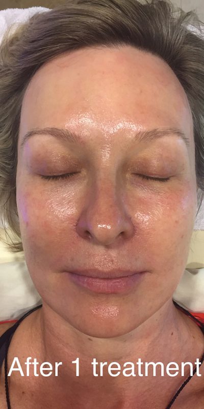 HydraFacial After Results Photo St. Louis