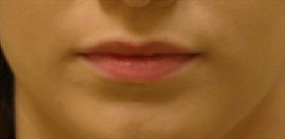 Lip Filler