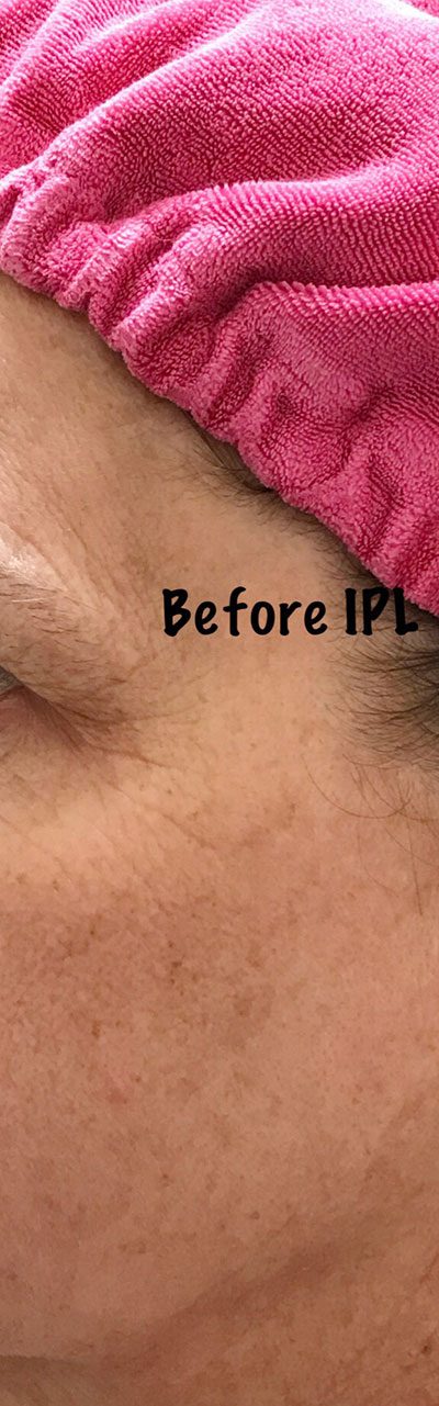 St. Louis IPL Before and After Photos - Des Peres Plastic Surgery Photo Gallery - Avani Derm ...