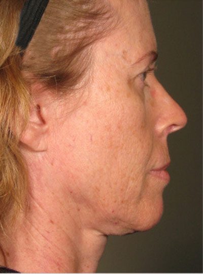 Ultherapy Before Photo