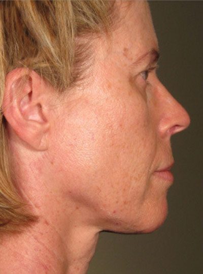 Ultherapy After Photo