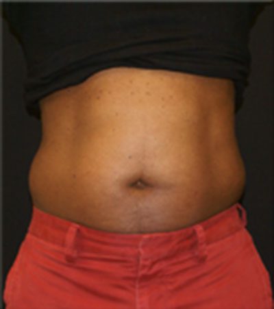 CoolSculpting