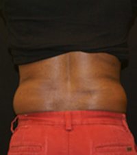 CoolSculpting