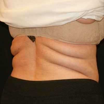 CoolSculpting